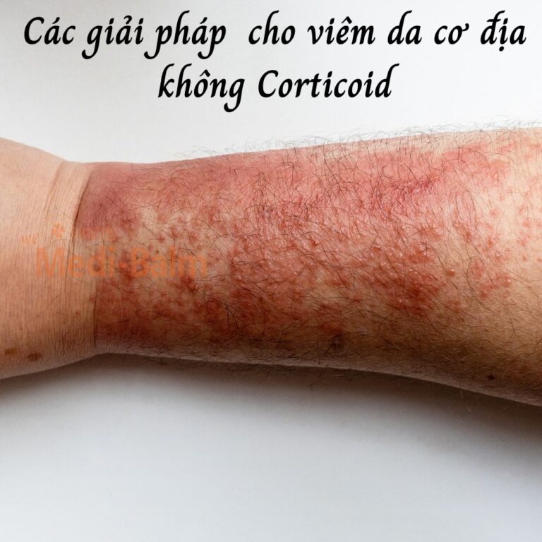 Giải pháp cho người viêm da cơ địa không corticoid