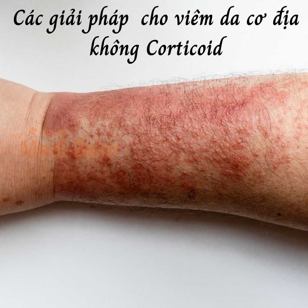 Giải pháp cho người viêm da cơ địa không corticoid