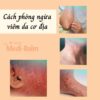 Cách phòng ngừa viêm da cơ địa