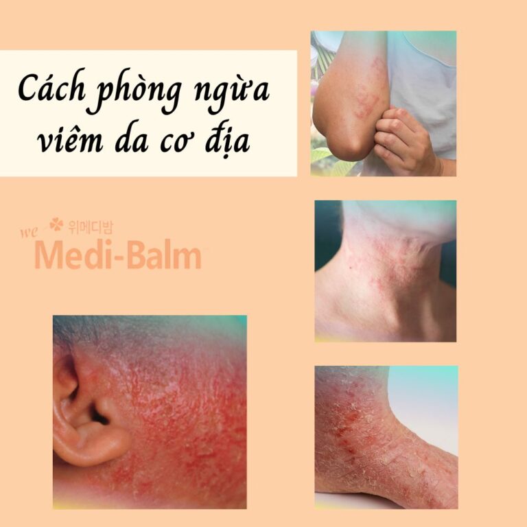 Cách phòng ngừa viêm da cơ địa