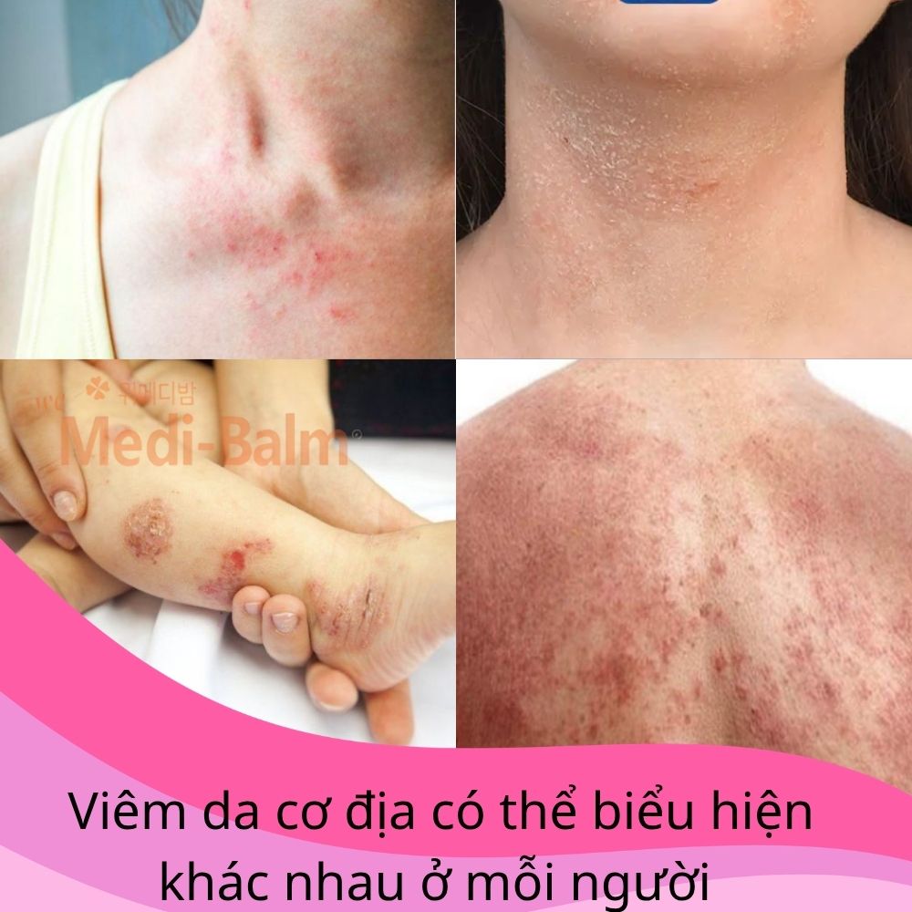Viêm da cơ địa có thể biểu hiện khác nhau ở mỗi người