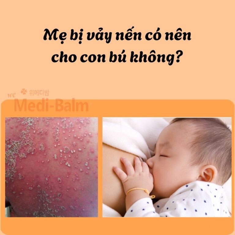 Mẹ bị vảy nến cho con bú có sao không