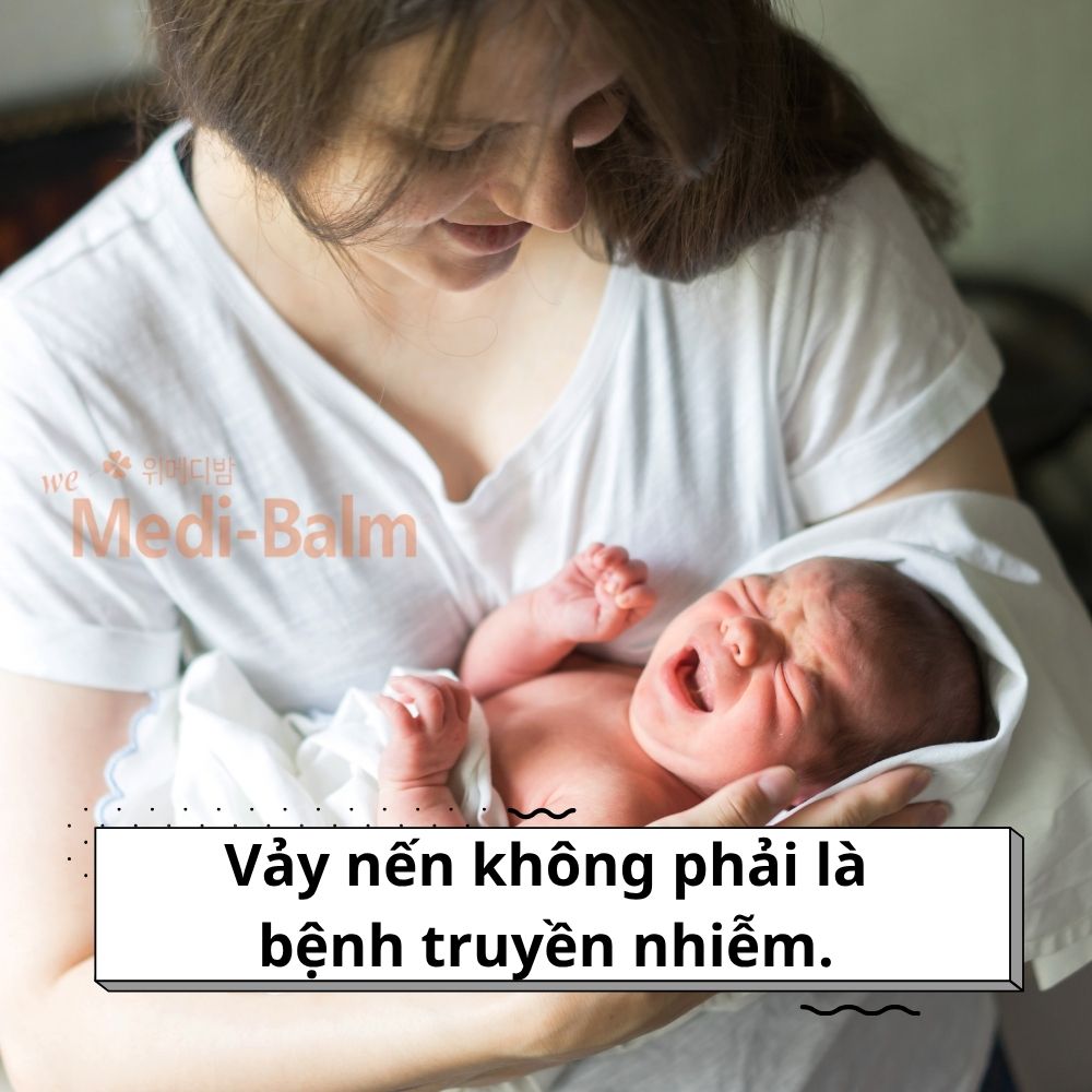 Vảy nến không phải là bệnh truyền nhiễm