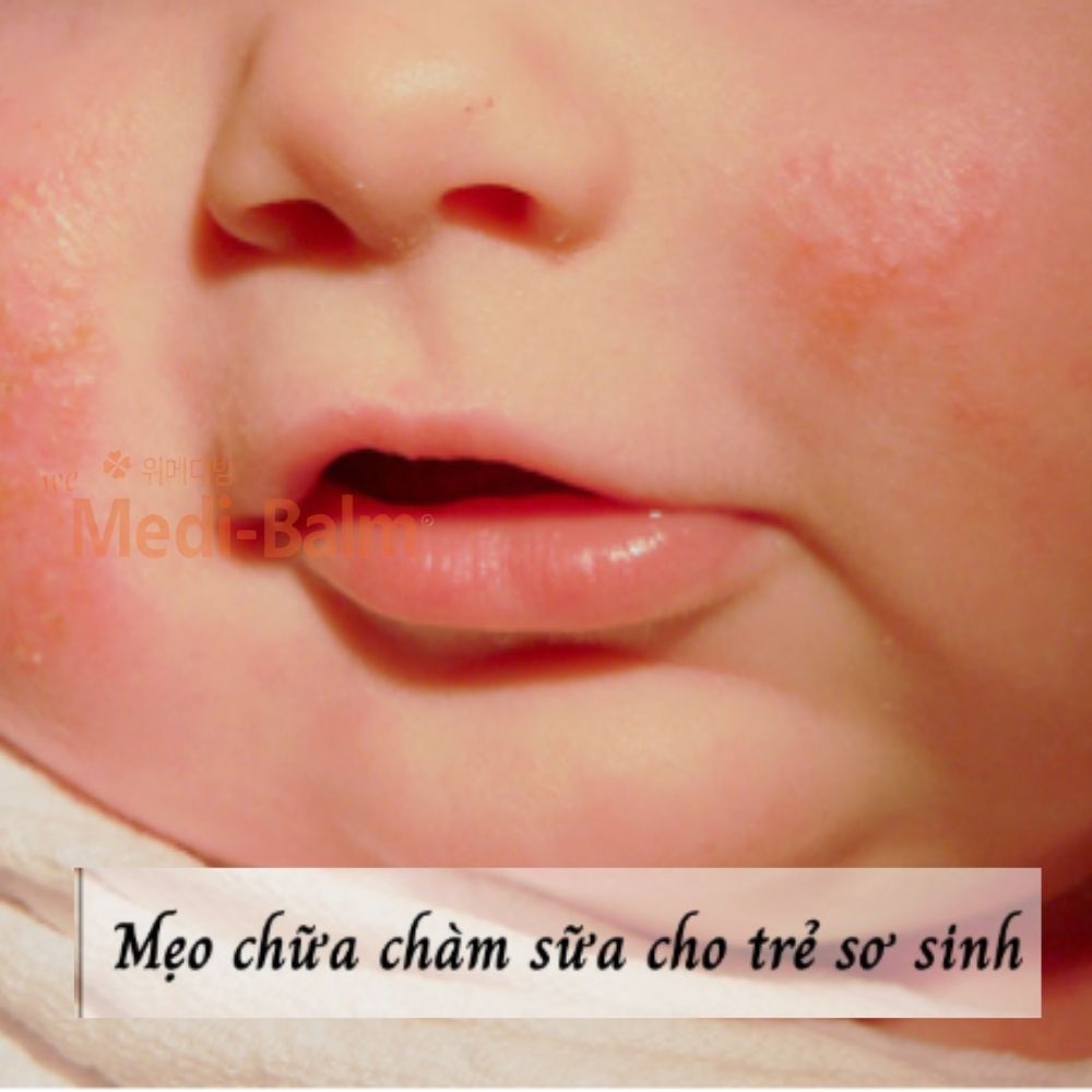 Mẹo chữa chàm sữa cho trẻ sơ sinh