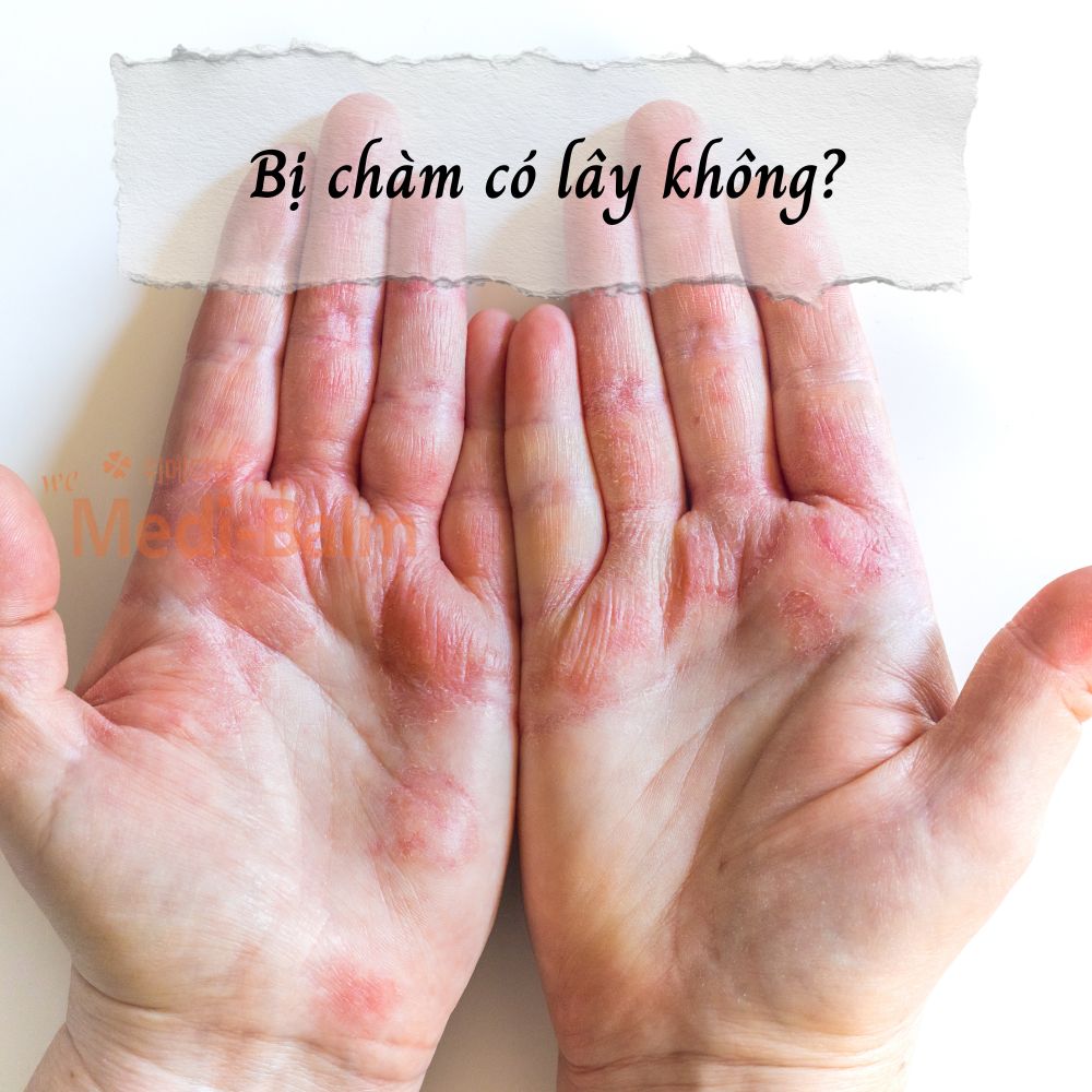 Bị chàm có lây không