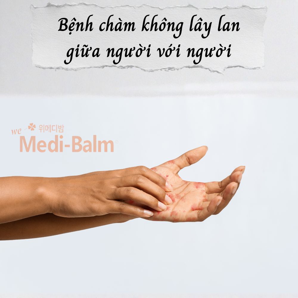 Bệnh chàm không lây giữa người với người